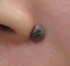 皮膚腫瘍 ほくろ 松尾形成外科 眼瞼クリニック 浜松市 まぶた 形成外科 美容皮膚科